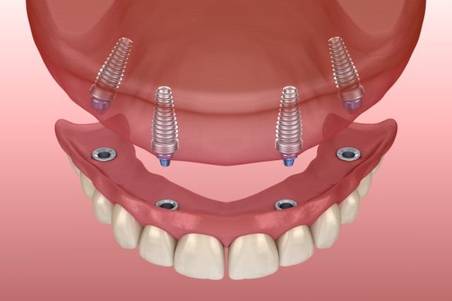 All-on-4 Teeth Replacement Technique 