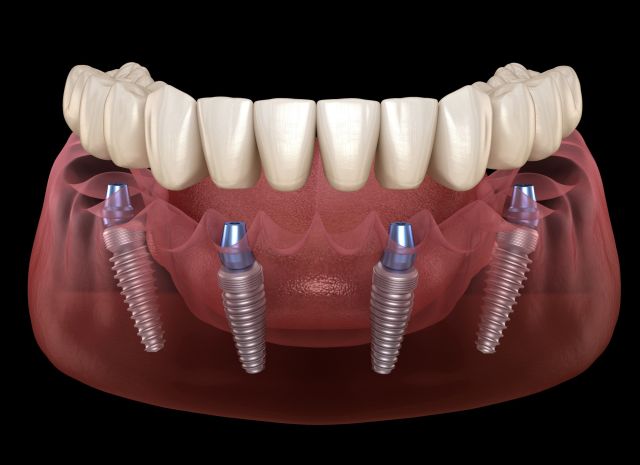 All-on-4 Teeth Replacement